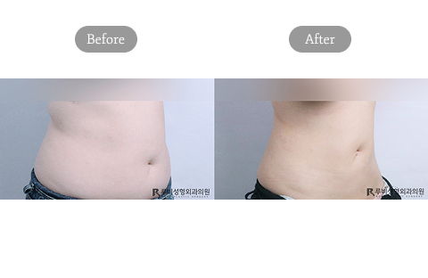 Abdomen And Flank Liposuction Before And After Results As Part Of Korean Liposuction Package