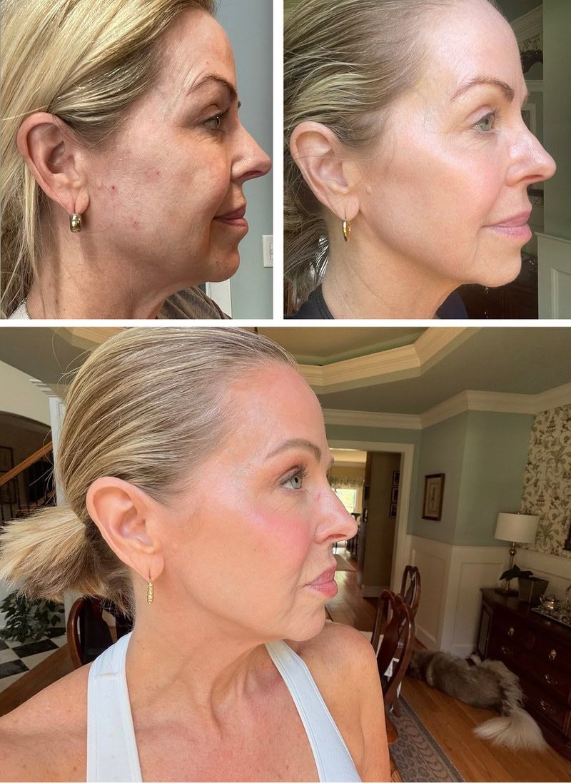 Before-and-after photos showing skincare results on a woman's face.