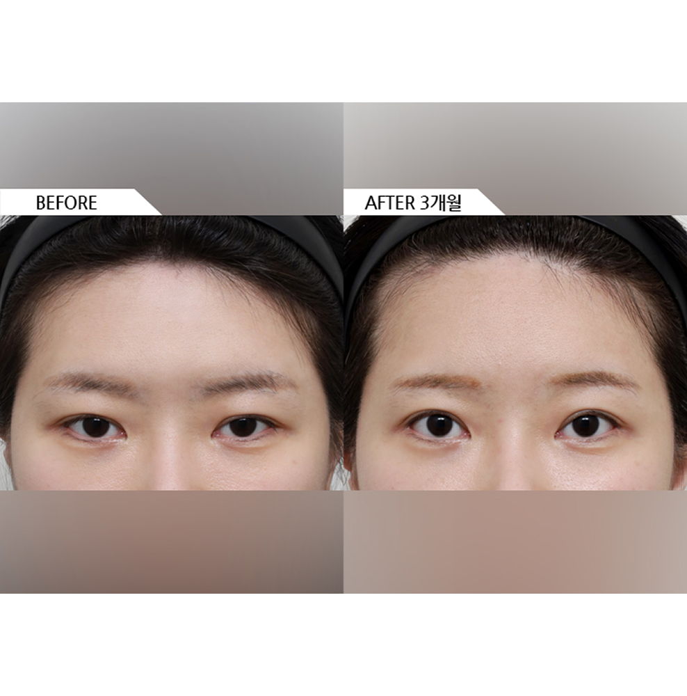 Before and after results of female forehead lift surgery showing lifted brows and a more youthful and refreshed appearance 3 months after surgery in Korea