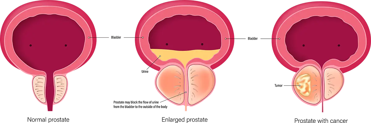 Illustration showing stages of prostate enlargement.