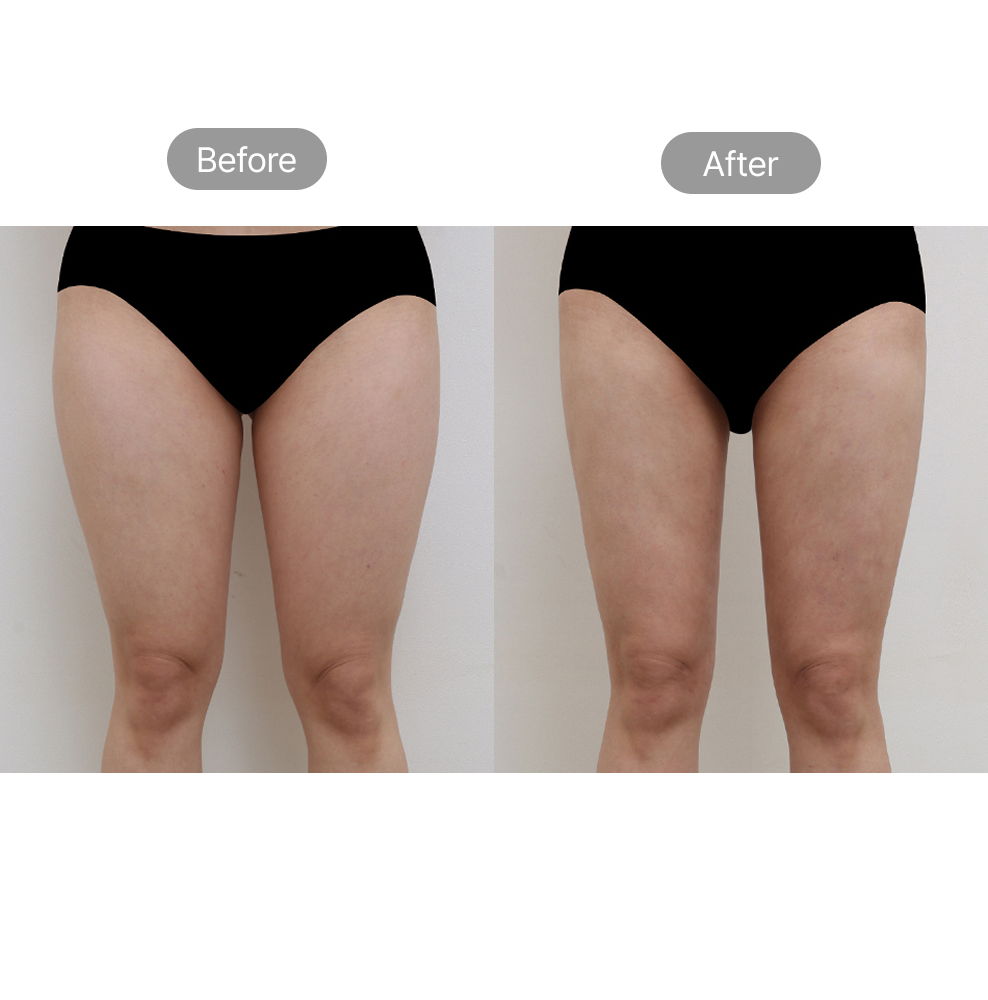 Thigh liposuction before and after results for slimmer legs and body contouring in Korea