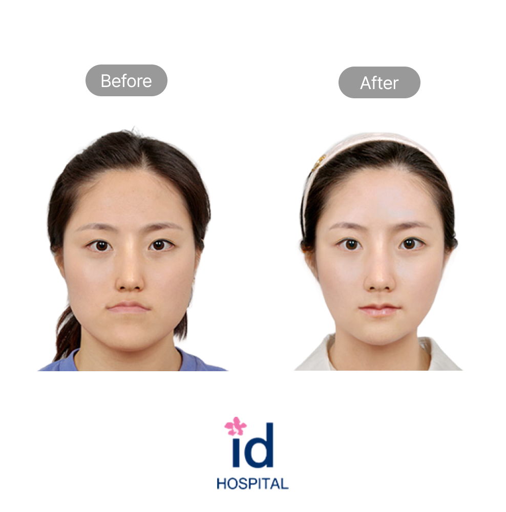 No-Tie Double Jaw Surgery Before and After Result at ID Hospital