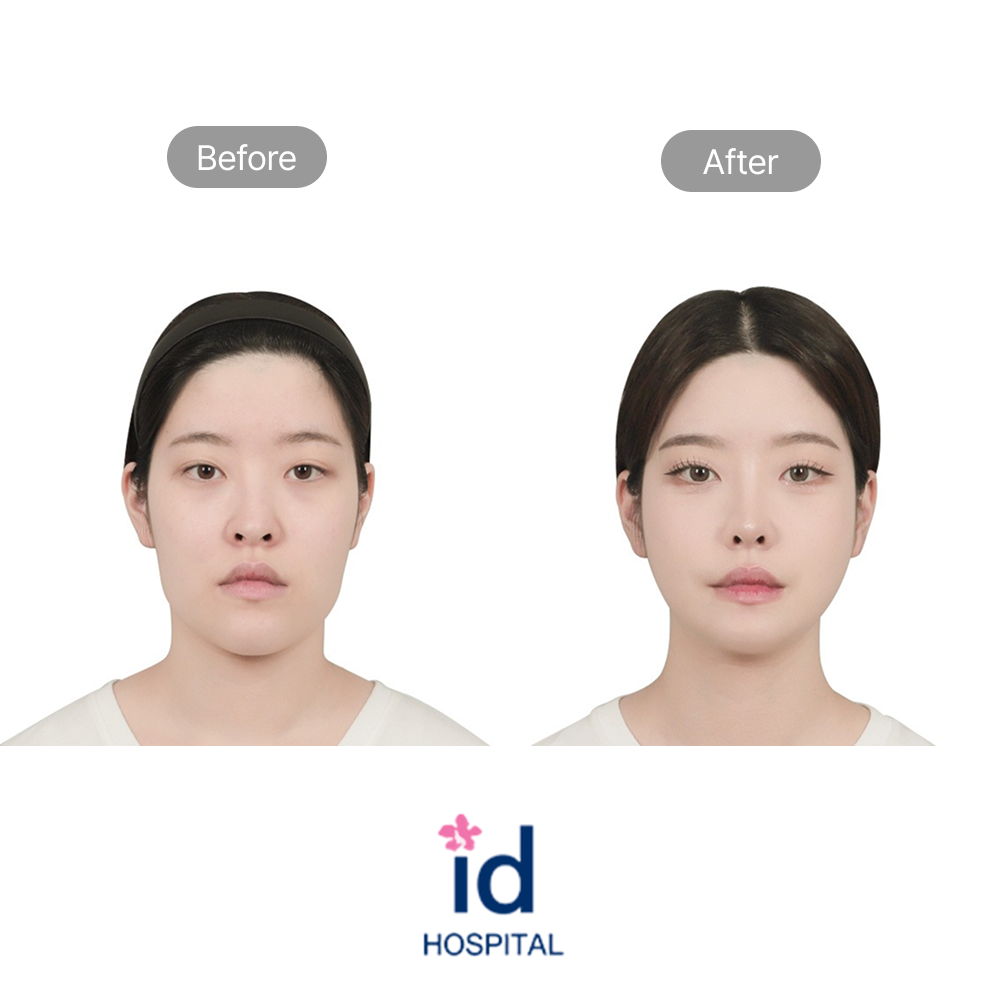 Facial Contouring Three Procedures Before and After Result at ID Hospital