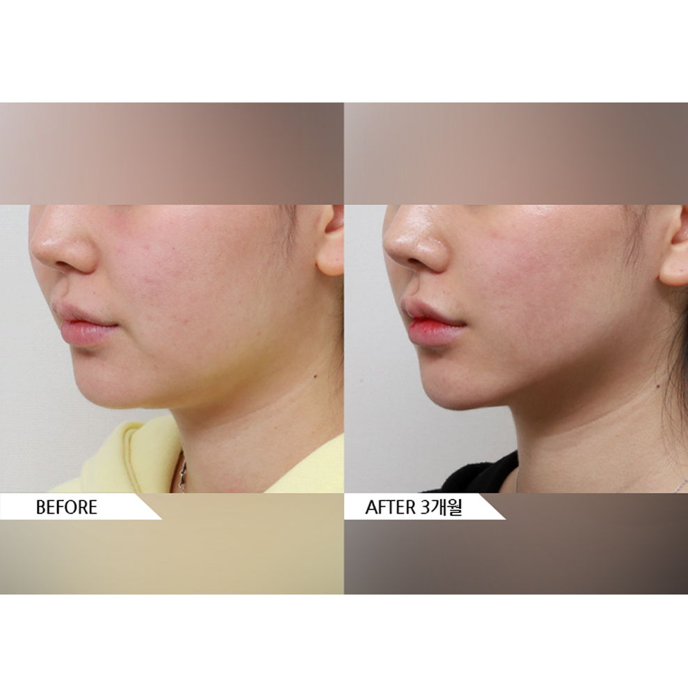 Before and after cheek and jawline fat removal showing a slimmer lower face contour and reduced facial volume 3 months after liposuction in Korea