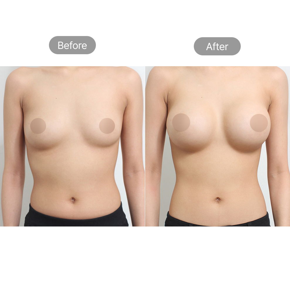 Breast augmentation before and after results at Fresh Dr. Hong Body Surgery Center in Korea