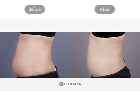 Lower Abdomen Liposuction Before And After Results Showing Body Fat Reduction At 1 Year In Korea