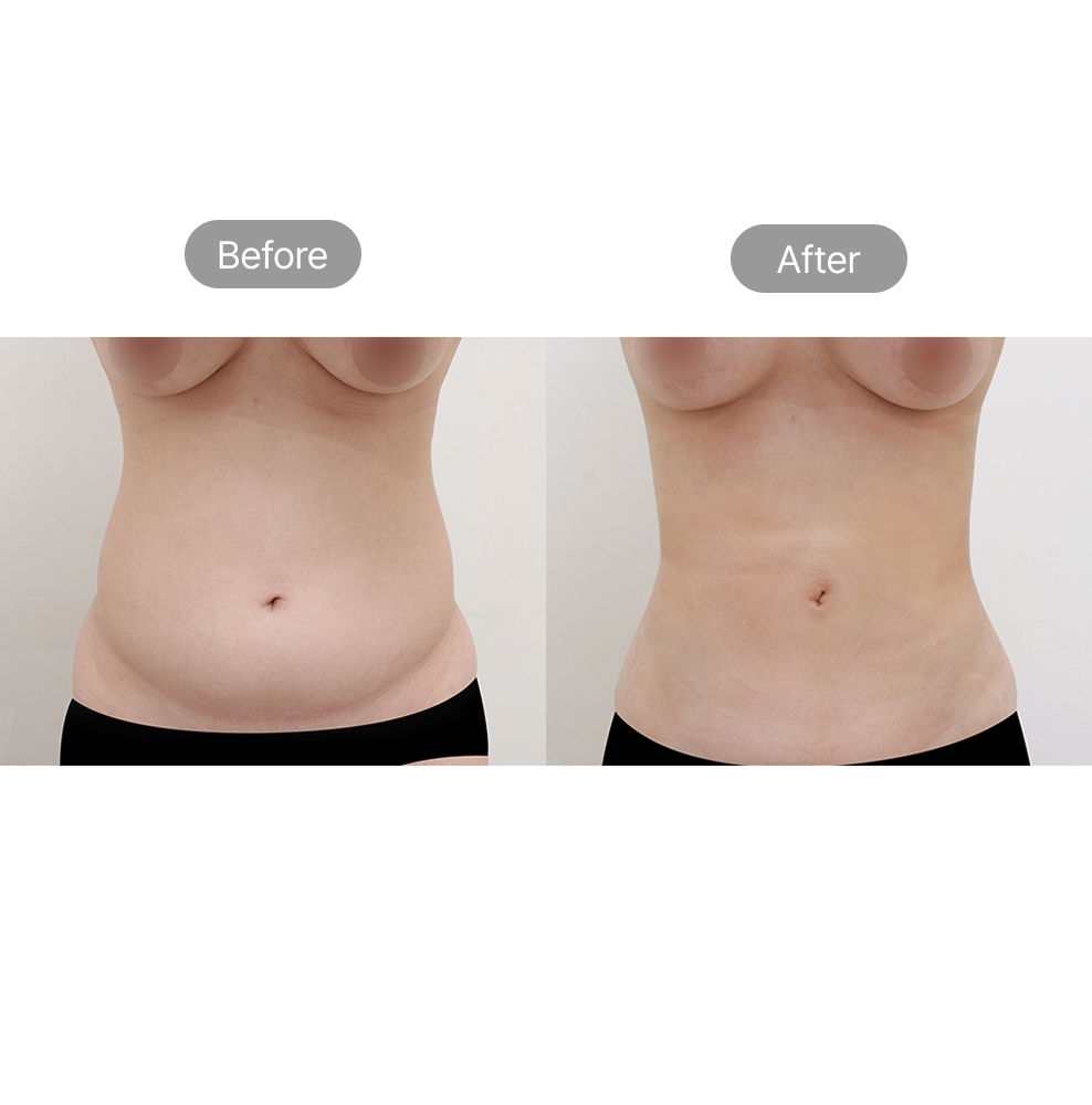 Waist liposuction before and after results for body contouring at Fresh Dr. Hong in Korea