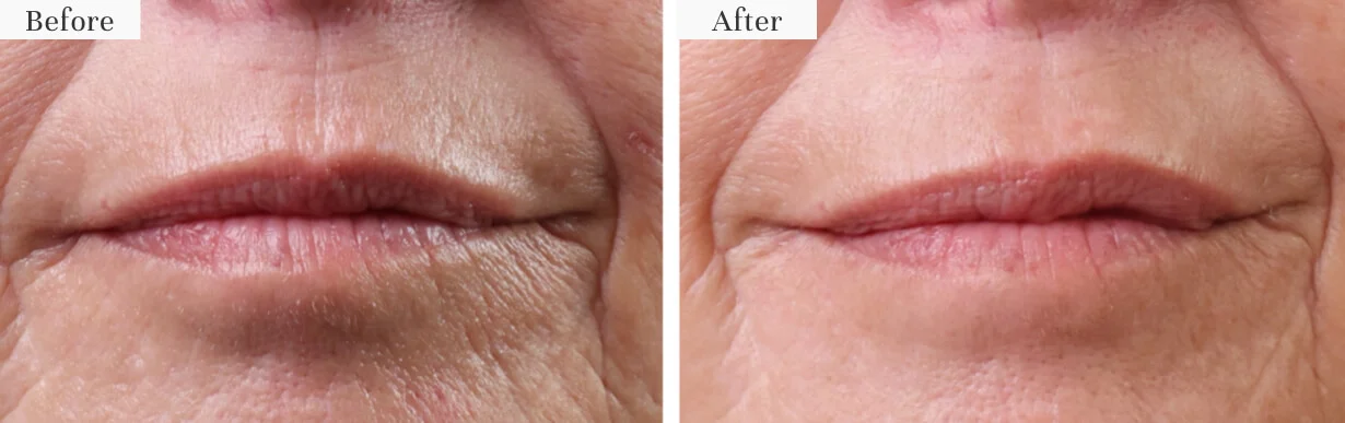 Comparison of lips before and after treatment.