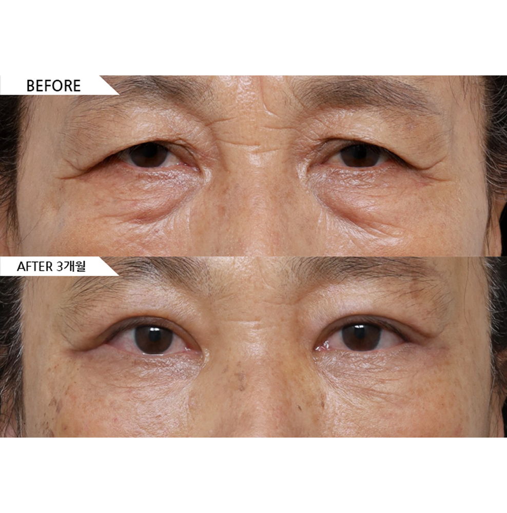 Before and after results of middle-aged eye surgery including double eyelid surgery, ptosis correction, lower eyelid surgery, and canthoplasty for brighter and rejuvenated eyes in Korea