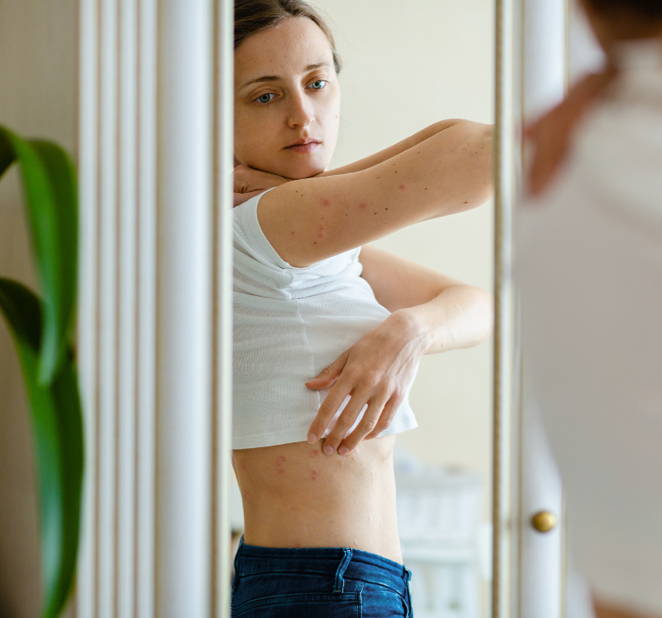 Woman lifting her t-shirt and looking in the mirror to see the itchy rash on her back. It could be allergic reaction hives