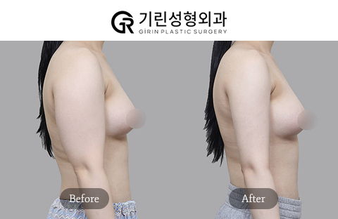Arm Liposuction Body Fat Reduction Before and After Results at Girin Plastic Surgery