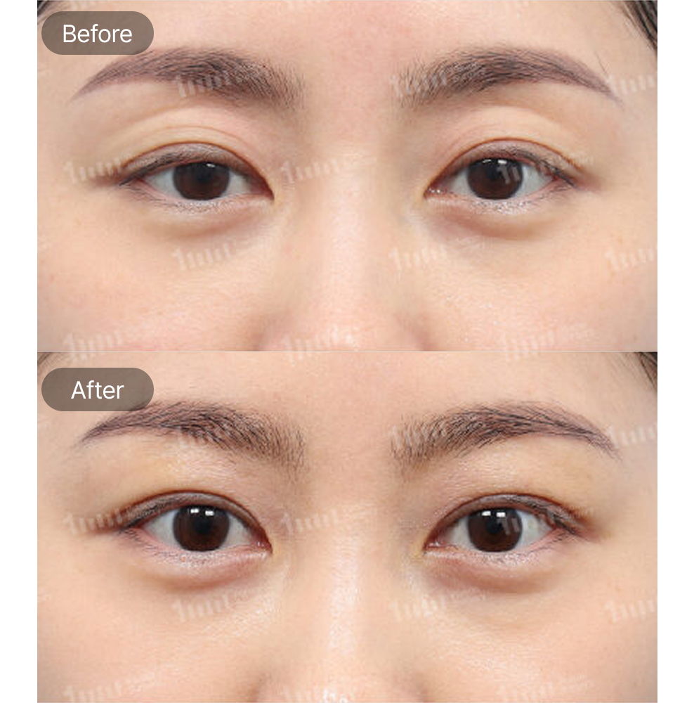 Non-Incisional Double Eyelid Surgery and Upper Epicanthoplasty Before and After Results at 1MM Plastic Surgery in Korea