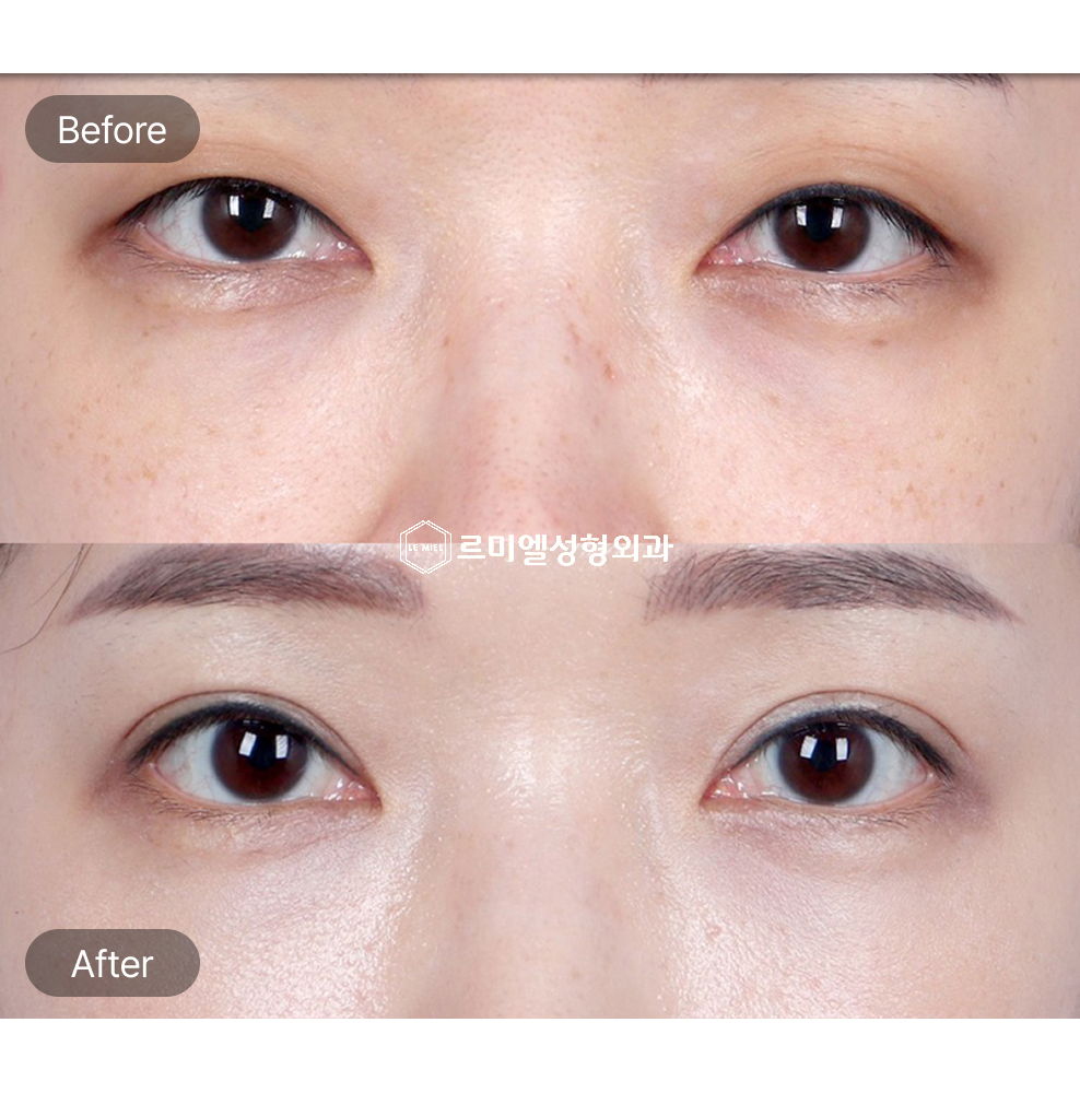 Before and After Results of Non Incisional Ptosis Correction After Five Months
