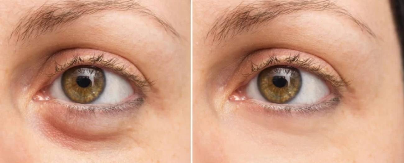 Before and after using depology products for crepey eye prevention