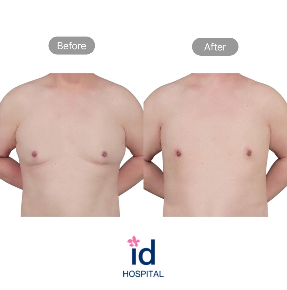 Male Gynecomastia Surgery Before and After Result at ID Hospital