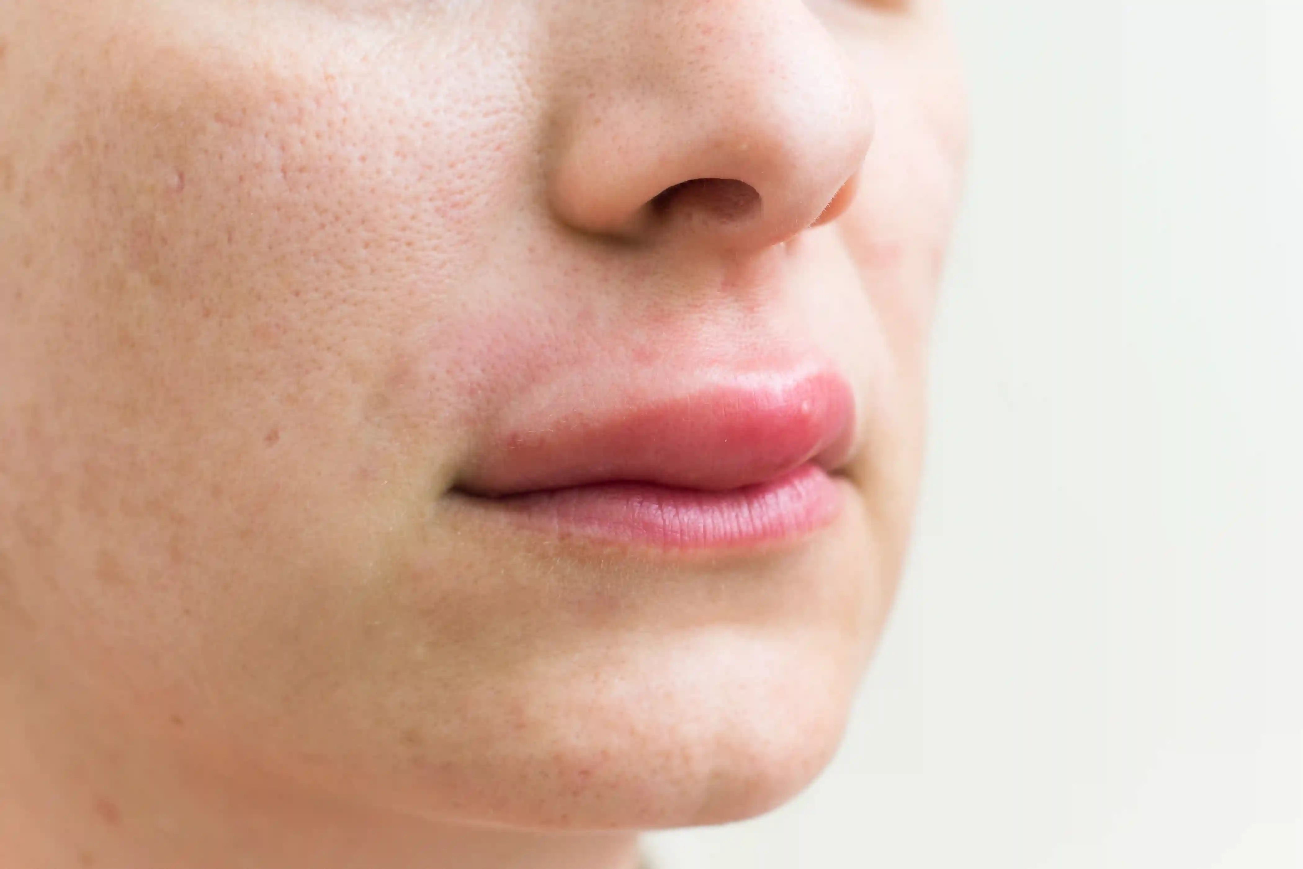 Close-up van het gezicht van een persoon met een duidelijke zwelling van de lippen en het gebied rond de mond, kenmerkend voor angio-oedeem.