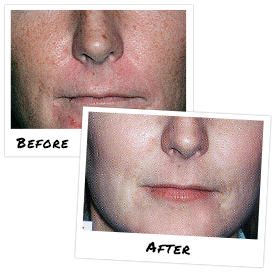 before and after Alpha Beta face Peels