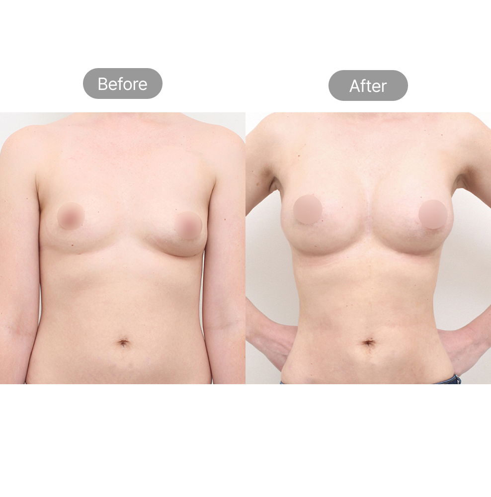 Breast fat transfer before and after results for natural body contouring at Fresh Dr. Hong in Korea