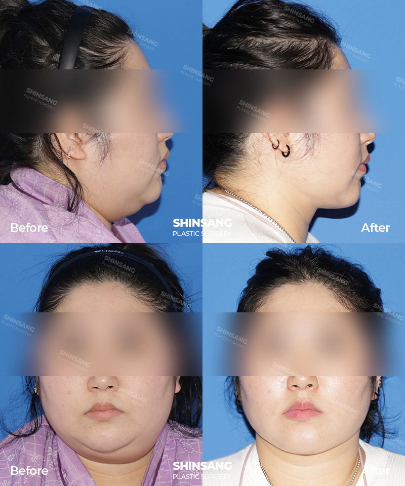 Double Chin Liposuction And Neck Lift Before And After At Sinsang Plastic Surgery In Korea