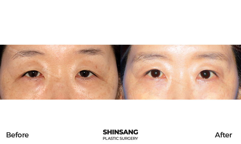 Upper Blepharoplasty And Ptosis Correction Result At Sinsang Plastic Surgery In Korea
