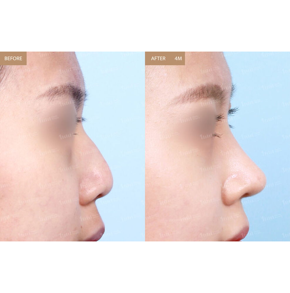 Hump Nose Rhinoplasty Before and After Results at 1MM Plastic Surgery in Korea for a Smooth and Refined Nose Profile