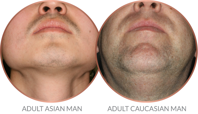 Stop Facial Hair From Growing Sale Price Save 43 Jlcatj gob mx