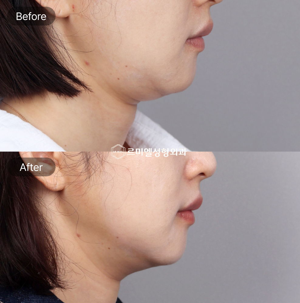 Before and After Results of InMode Lifting Treatment After Two Months
