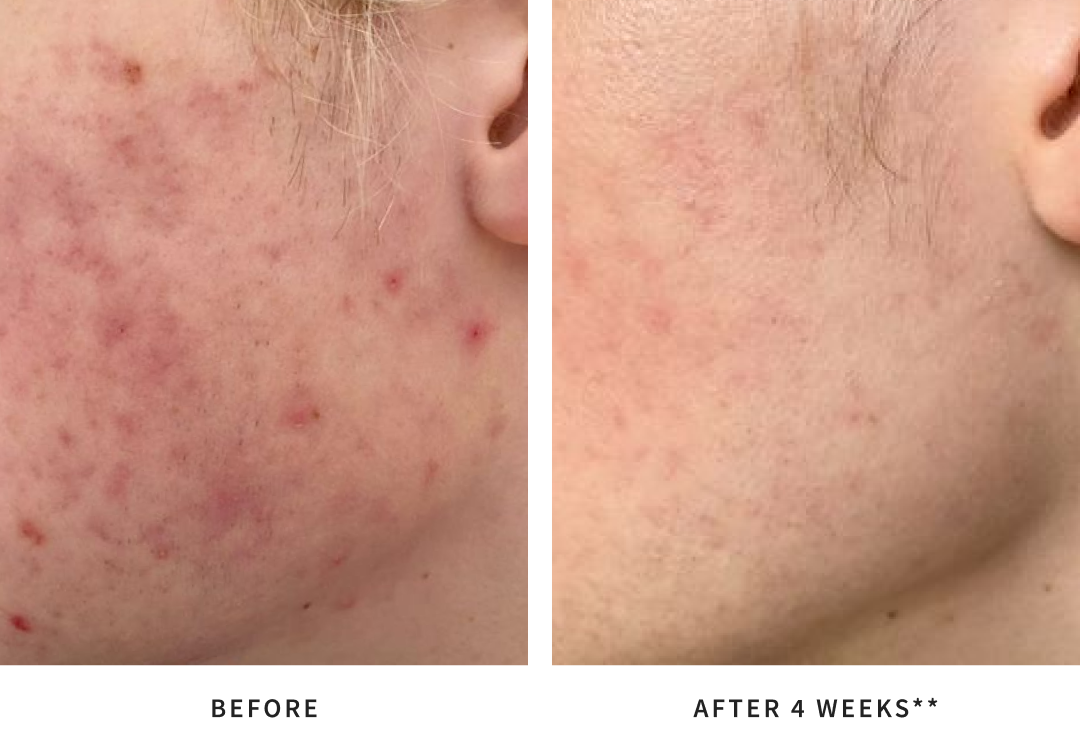 Before and after using Antipodes probiotic skincare.