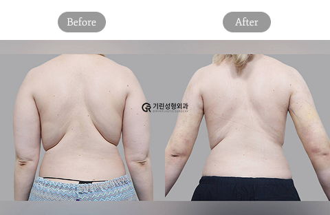 Arm And Bra Line Liposuction Before And After Results Showing Upper Body Fat Reduction In Korea