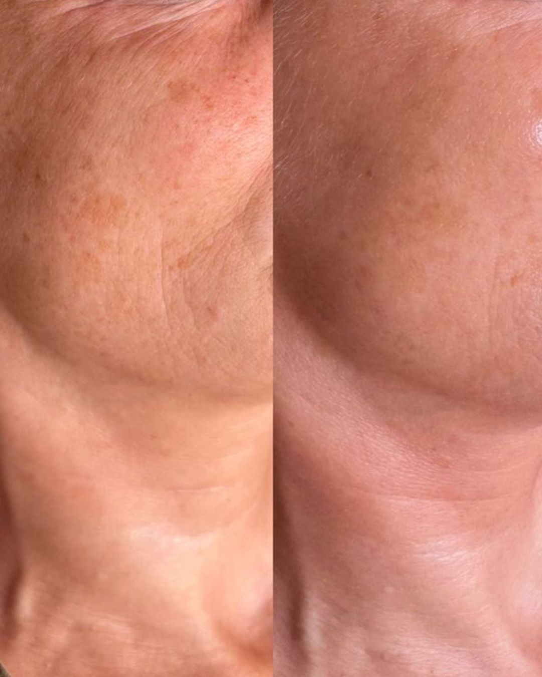 #seo: before/after Innerskin