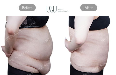 Mommy Makeover Korea Tummy Tuck Before and After Results at Wonjin Plastic Surgery Clinic