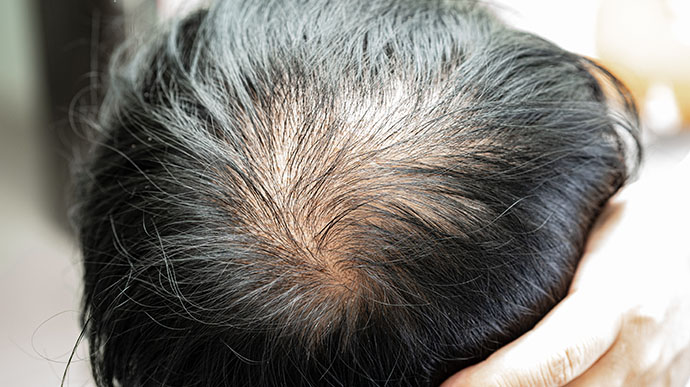 hair loss products men