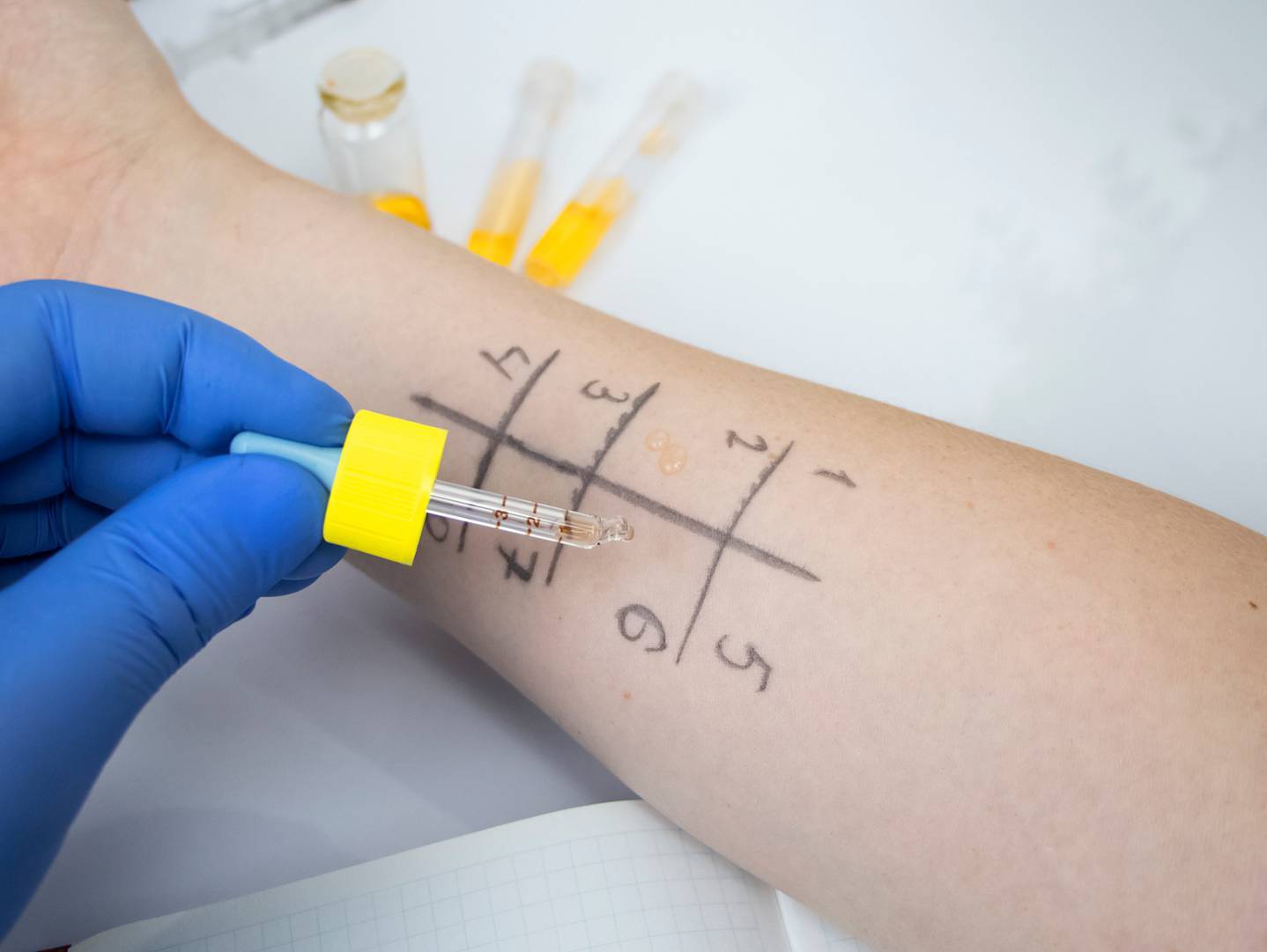Lékař provádí kožní prick test na alergie. Kapky různých alergenů aplikuje do mřížky nakreslené na předloktí pacienta.