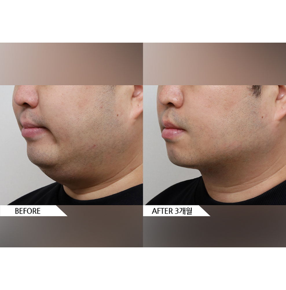 Before and after male facial liposuction combined with jaw botox showing reduced double chin, slimmer jawline, and masseter muscle reduction 3 months after treatment in Korea