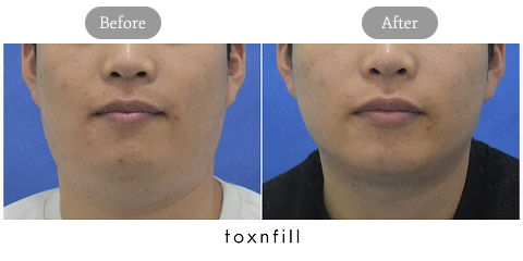 Male Plastic Surgery in Korea Featuring RF Skin Tightening for Non-Surgical Jawline Refinement and Double Chin Reduction