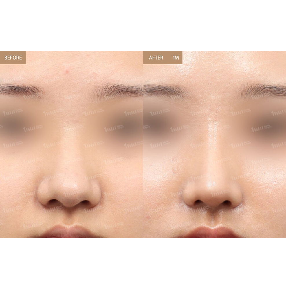 Bulbous Nose Rhinoplasty Before and After Results at 1MM Plastic Surgery in Korea for a Slimmer and More Refined Nose Shape