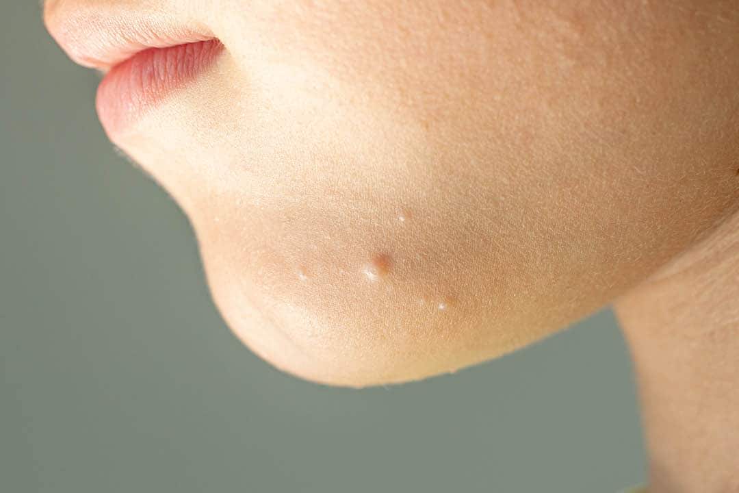 This is a picture of pimples on a chin.
