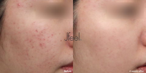 Post Acne Redness Laser Treatment Showing Four Week Skin Improvement