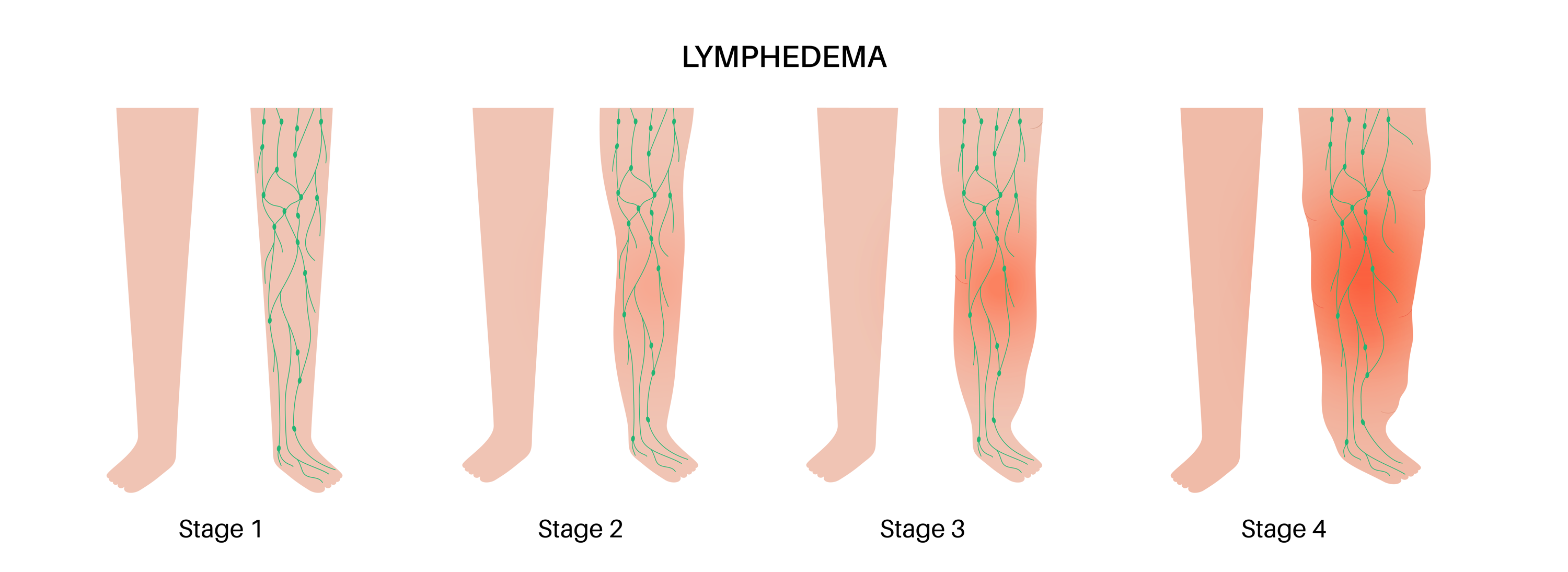 Illustration of stages of lymphedema