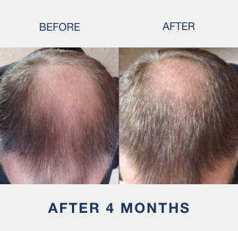 man showing before and after of crown hair loss reversed by the illumiflow 272 pro
