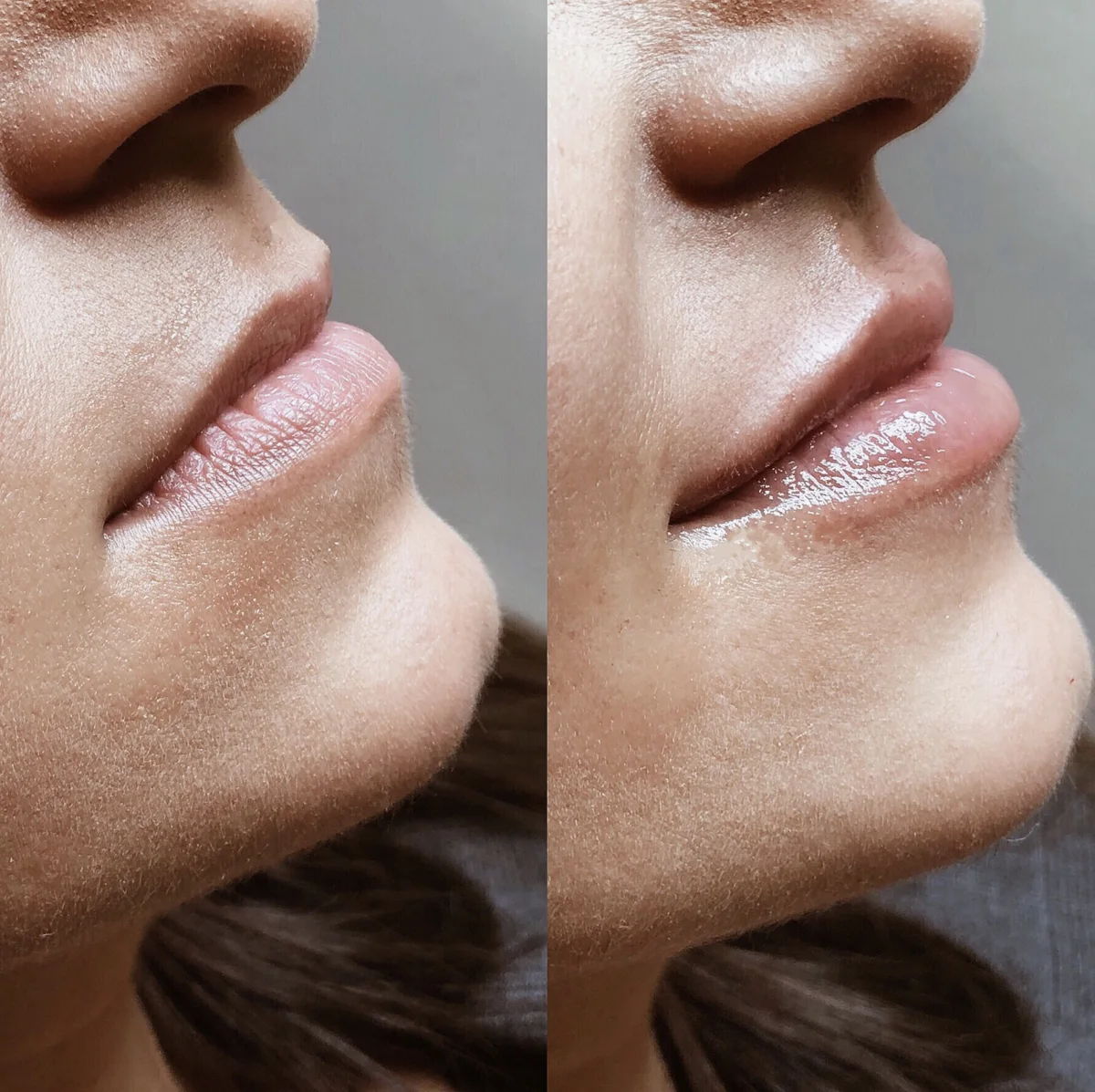 Before and after comparison of lip enhancement procedure.