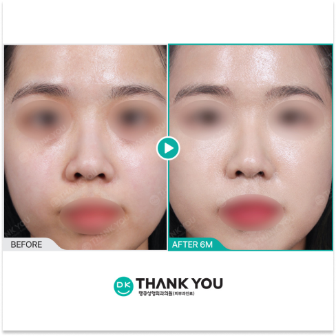 Juvelook Volume Before and After 6 Months for Full-Face Volume Restoration in Seoul