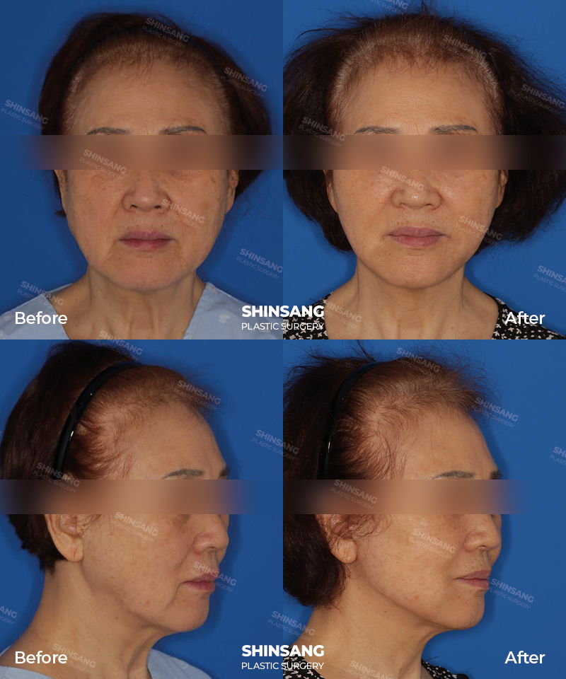 Full Facelift Patient Result At Sinsang Plastic Surgery In Korea