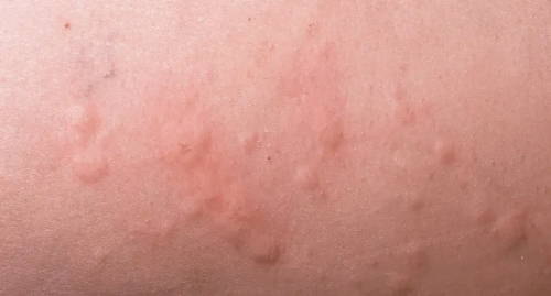 Raised bumps and reddened skin typical of hives, which can be an allergy symptom
