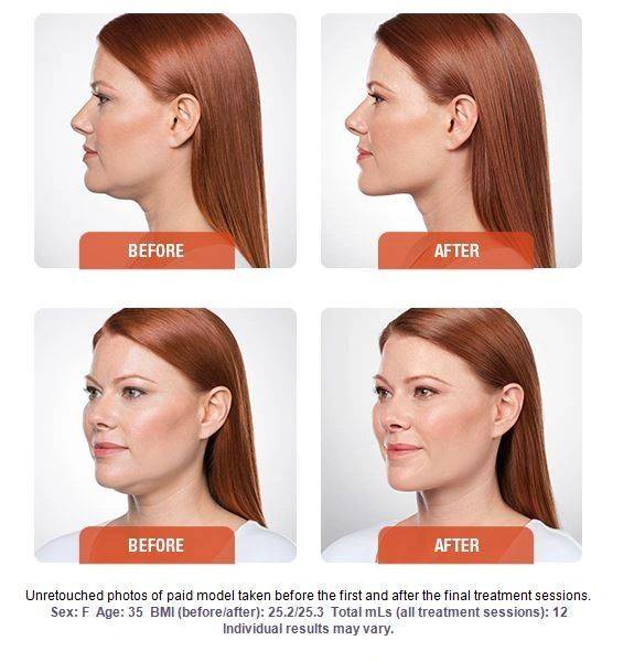 Kybella Before & After Picture