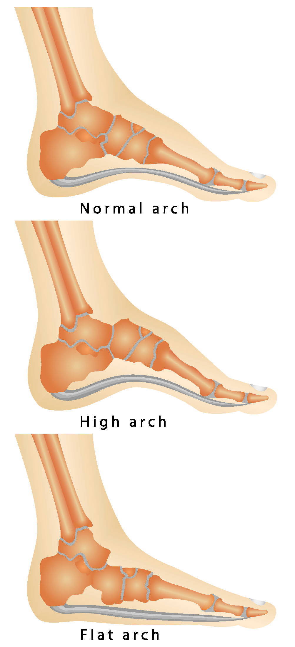 running with flat feet