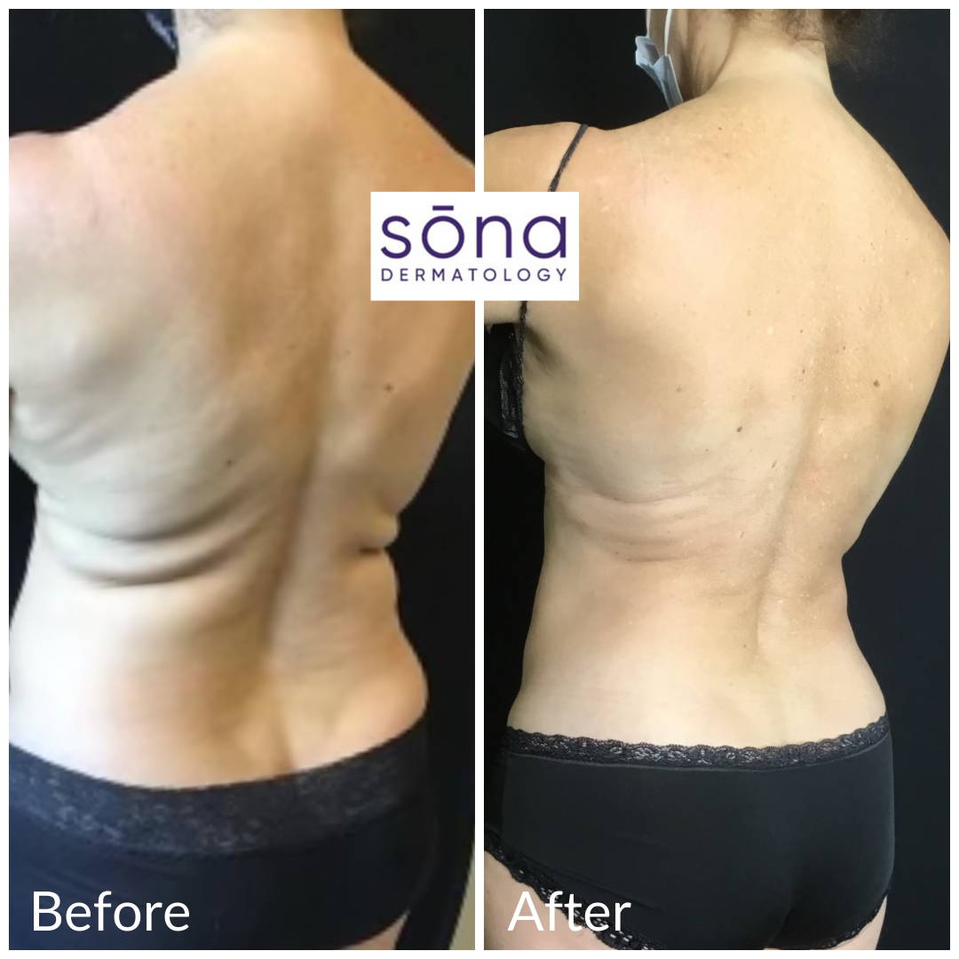 Sona CoolSculpting Before & After