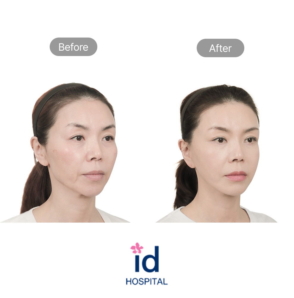 Lower Face Lift and ID SMAS Lift Before and After Result at ID Hospital