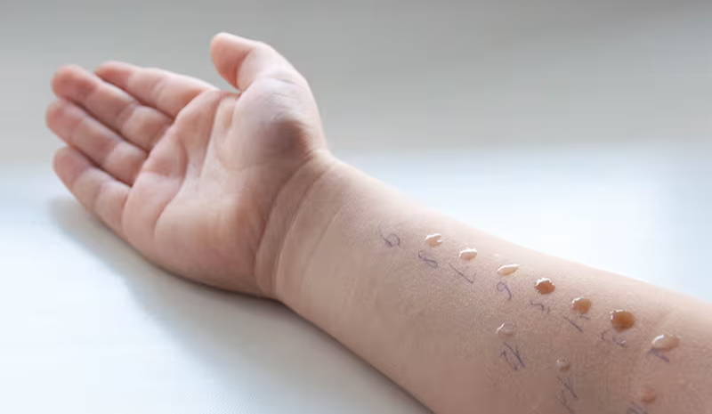 Dětská ruka během kožního prick testu – kapky tekutiny obsahující malé množství alergenů mohou způsobit reakci podobnou štípanci od komára