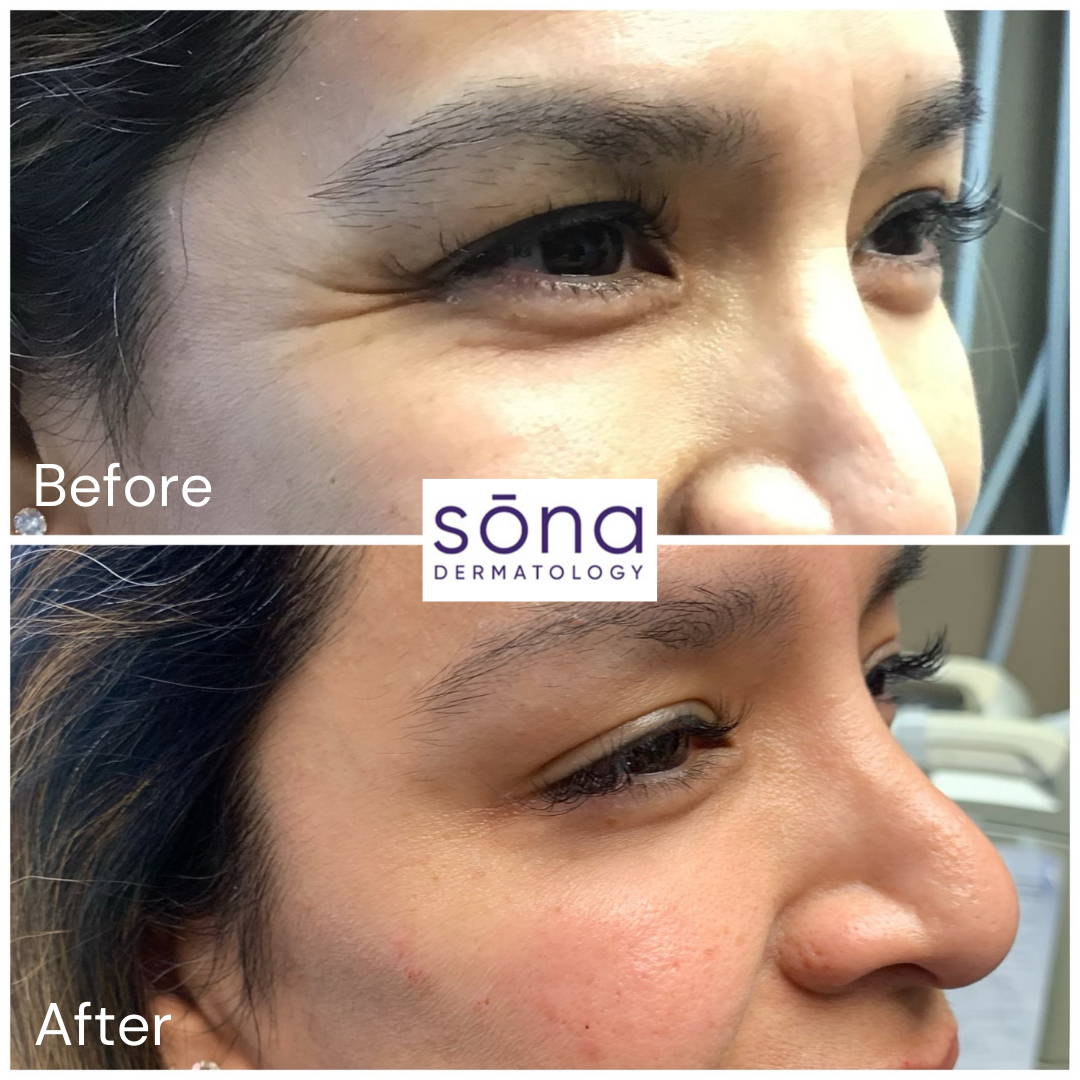 Sona - Botox Cosmetic Before & After 2